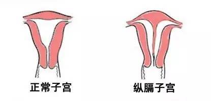 宫颈畸形对女性有什么影响吗