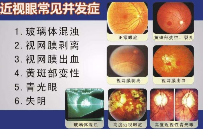 近视眼五大并发症需小心万一中招很可怕