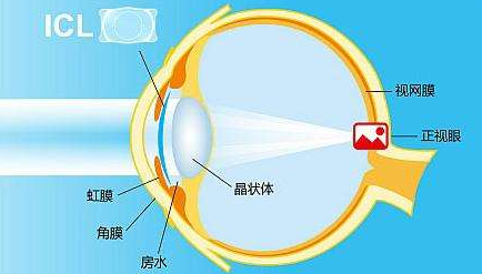 眼睛晶体植入手术多少钱?3.4-3.8万元之间!